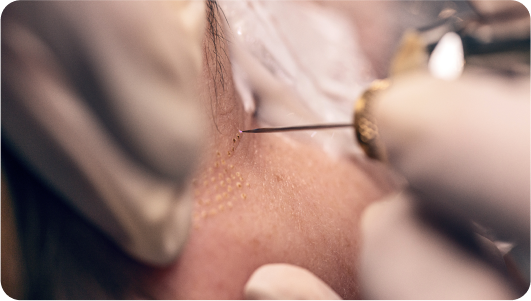 Fibroblast-Treatment
