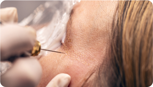 Fibroblast-Treatment.