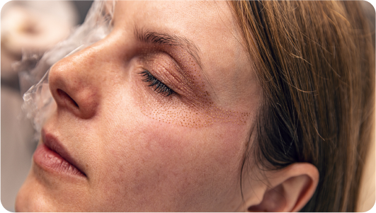 Fibroblast-Treatment