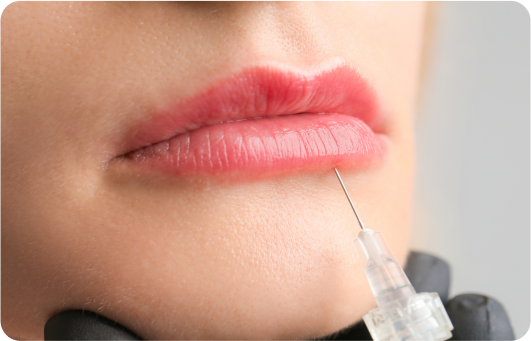 Lip-Fillers